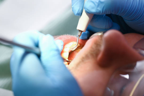 Best Broken or Cracked Tooth Emergency Dentist in Sanborn, NY