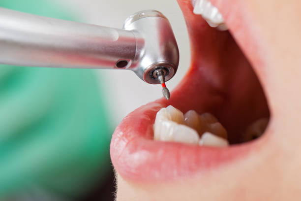 Best Emergency Dentist for Lost Fillings or Crowns in Sanborn, NY